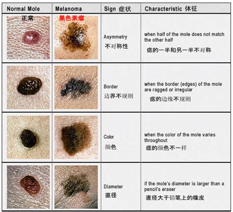 屁股的痣|痣也可能会癌变！长在 3 个地方要注意